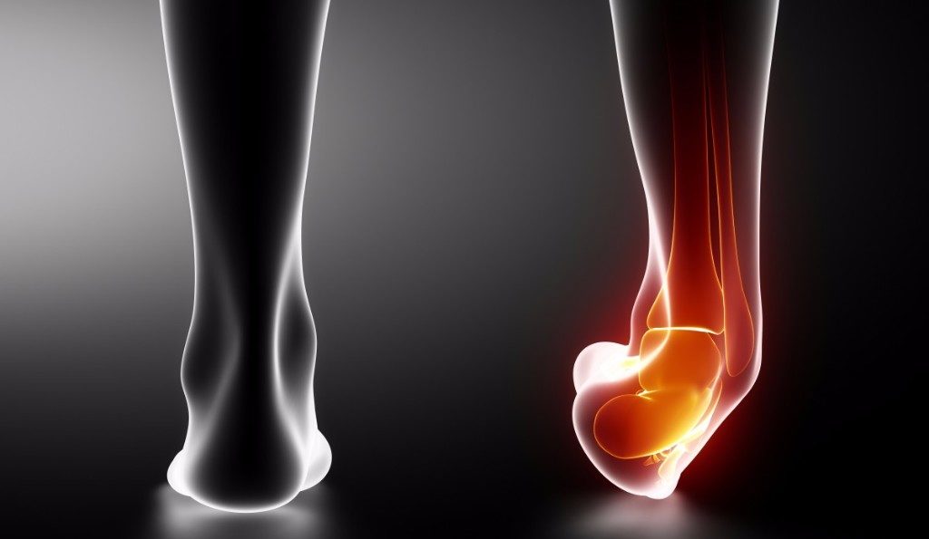 ankle sprains